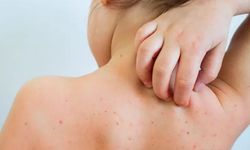 Okullarda suçiçeği alarmı! Veliler tedirgin: Bu belirtiler varsa dikkat