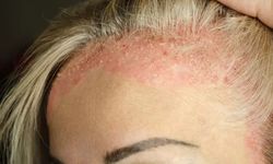 Kaşıdıkça artan tehlike: Soğuk hava egzamayı tetikliyor mu?