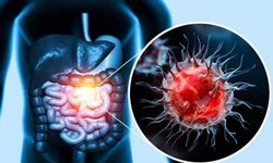 Ailede kolon kanseri varsa dikkat! Taramalara 10 yaş erken başlayın