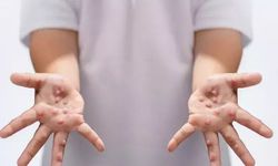 Çocuklarda hızla bulaşıyor! Ağız yaraları ve döküntülerle geliyor: Hafife almayın