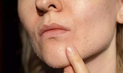 Bahar mevsimi cildinizi bozabilir! Bu üç tehlikeyi göz ardı etmeyin