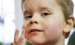 Egzaması olan bebekler için altın değerinde tavsiyeler