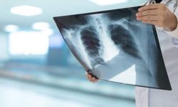 Zatürre tedavisinde doğal yöntemler ve alternatif çözümler