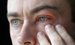 Blefarit nedir? Türleri, nedenleri ve tedavisi…