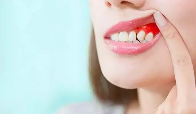 ‘Diş eti hastalıkları kalp ve damar sağlığını olumsuz etkiliyor’