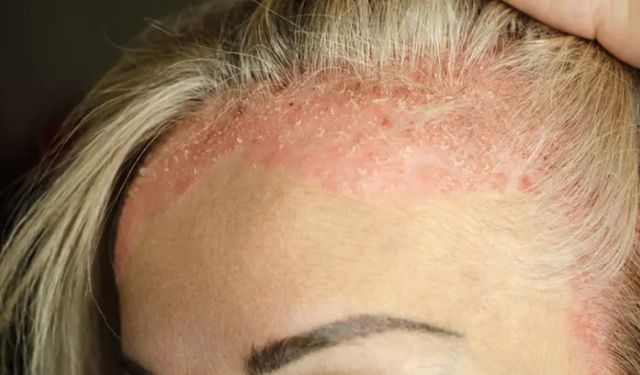 Kaşıdıkça artan tehlike: Soğuk hava egzamayı tetikliyor mu?