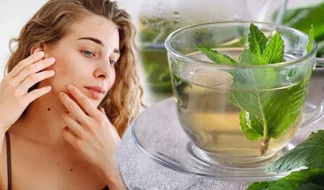 Kıvırcık nane çayı hormonal akneye iyi gelir mi?