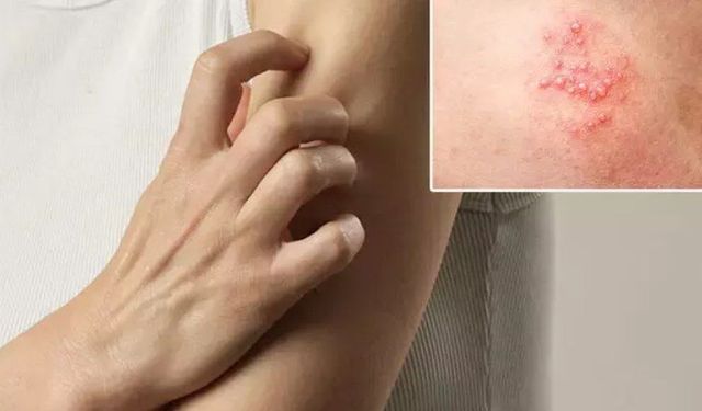 Sessiz başlayan hastalık: Zona! 72 saat içinde tedaviye başlanmalı