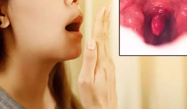 Dış fırçalamaya rağmen geçmeyen ağız kokusunun nedeni: Bademcik taşları