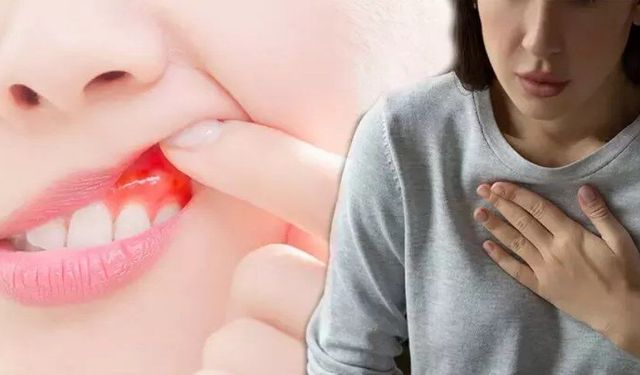 Diş eti kanaması masum değil! Kalp hastalıkları, Alzheimer ve kanserle yakından ilişkili