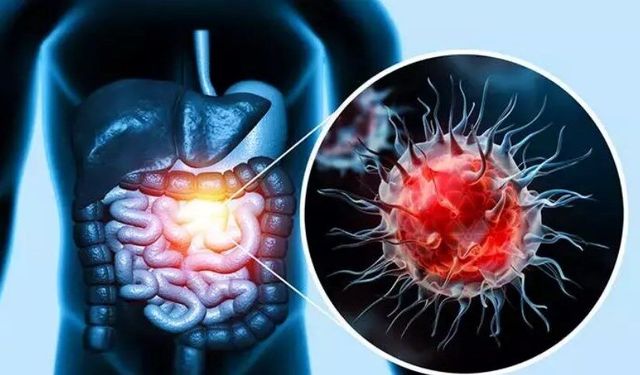 Ailede kolon kanseri varsa dikkat! Taramalara 10 yaş erken başlayın