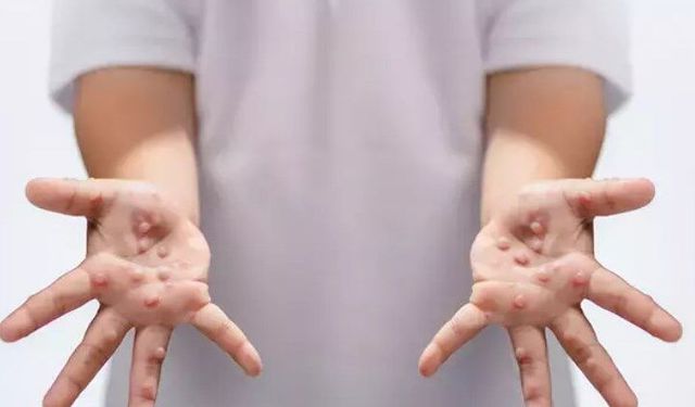 Çocuklarda hızla bulaşıyor! Ağız yaraları ve döküntülerle geliyor: Hafife almayın