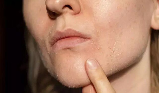 Bahar mevsimi cildinizi bozabilir! Bu üç tehlikeyi göz ardı etmeyin