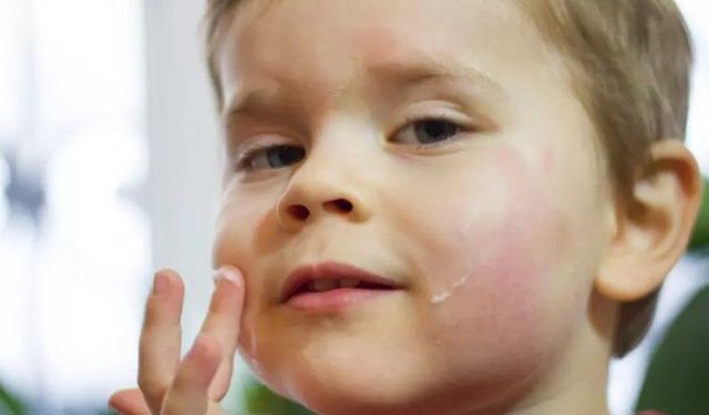 Egzaması olan bebekler için altın değerinde tavsiyeler