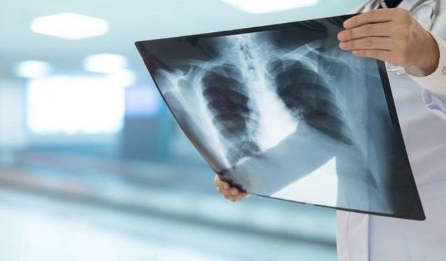 Zatürre tedavisinde doğal yöntemler ve alternatif çözümler