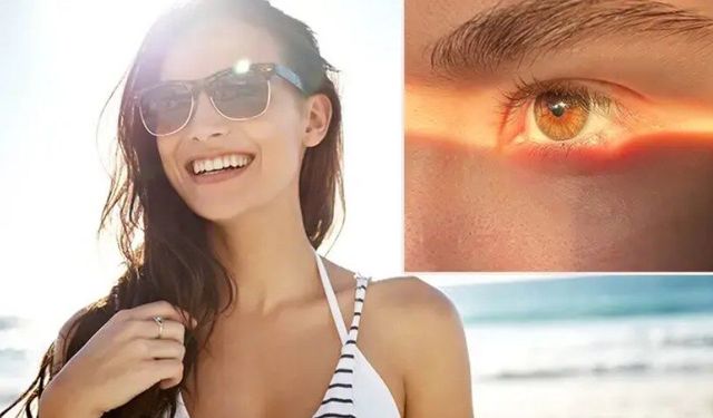 Gözünüz de güneş yanığı olabilir! Fotokeratit tehlikesine dikkat: Gözlükte bu özellik şart