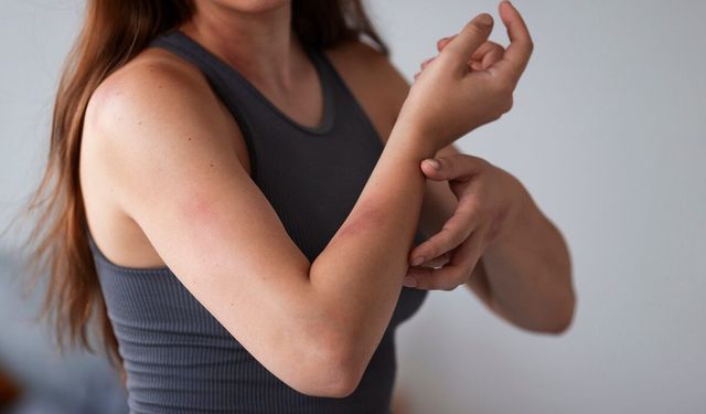 Alerji mi, histamin dengesizliği mi? Histamin dengesizliği nedir?