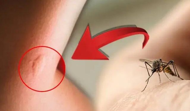 Fazla ısırık alerjiye dönüyor! Sivrisineklerin ısırmasına razı olmayın: Şişip ısınıyor
