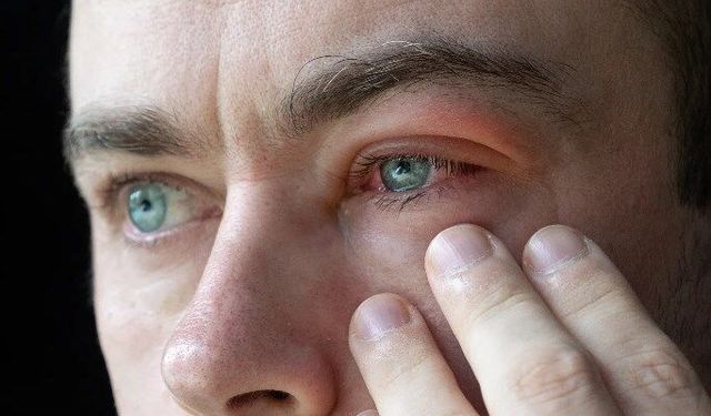 Blefarit nedir? Türleri, nedenleri ve tedavisi…