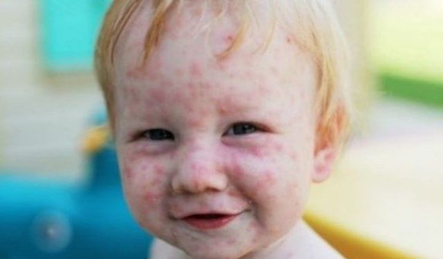 Çocukluk çağı lupus: Belirtileri, tanısı ve tedavisi