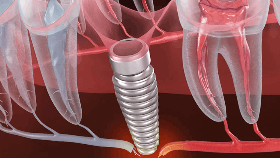 Implant